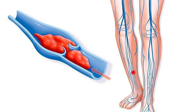 Тромбоз глубоких вен нижних конечностей: симптомы и признаки, методы лечения