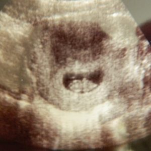 Нормы первого узи при беременности 33