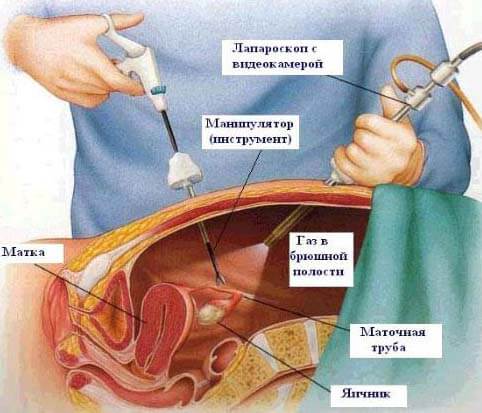 laparoskopiya 