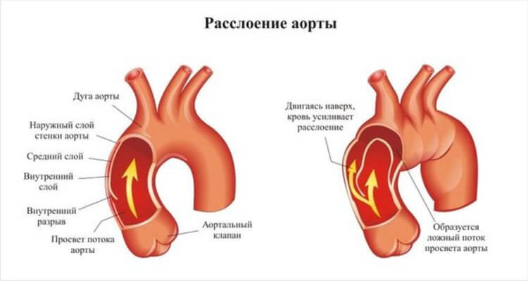 anevrizma-aorty-lechenie