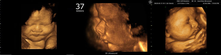 УЗИ-на-37-неделе-беременности
