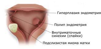 patologiya_endometryi