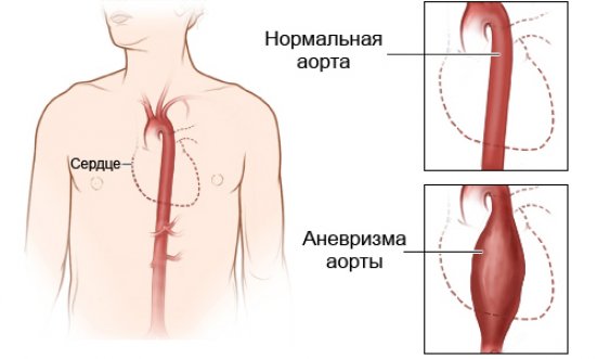 Shema-rassloenija-aorty