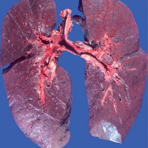 pulmonary_hemosiderosis