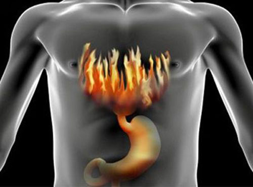 Ожог пищевода: симптомы, осложнения, первая помощь и лечение ...