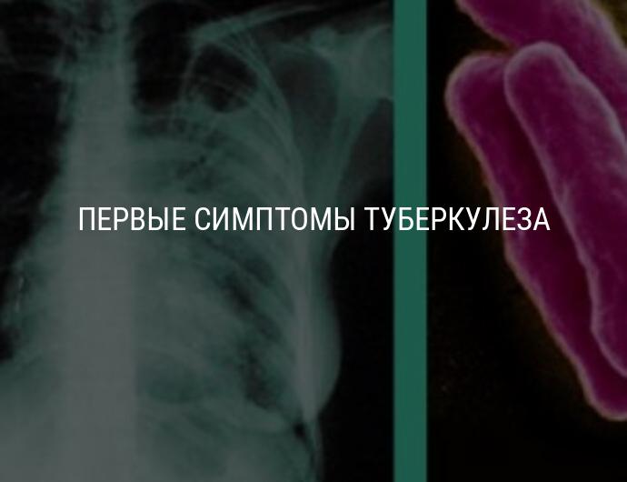 Начальная стадия туберкулеза у взрослых. Туберкулез на ранних стадиях. Начальная стадия туберкулеза на снимке.