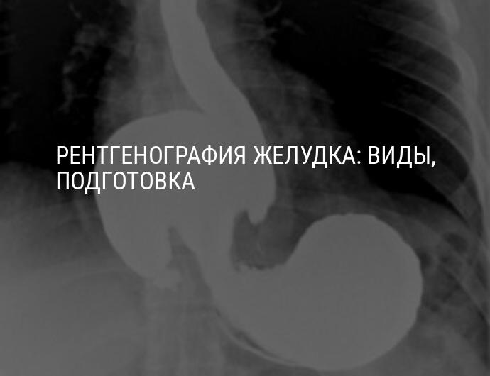 Рентген с барием пищевода и желудка подготовка. Снимки желудка с барием. Подготовка к рентгенографии желудка с барием.
