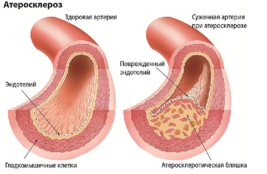 ateroskleroz
