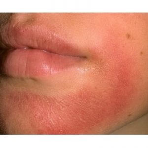 allergicheskiy-dermatit-na-lice