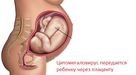Беременность и торч инфекции герпес thumbnail