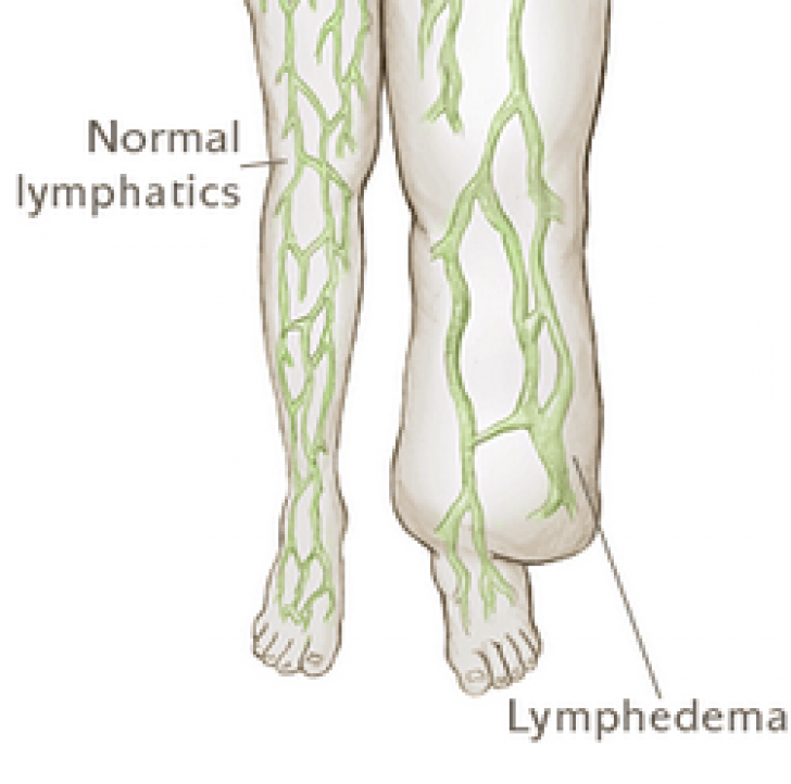Лимфоузлы синдром. Лимфедема это лимфатический отек. Лимфостаз нарушение лимфооттока. Лимфостаз слоновая болезнь.