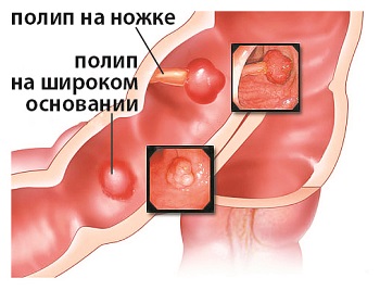 Лечение злокачественных полипов желудка thumbnail