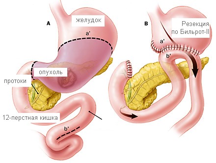 Множественный полипоз желудка лечение thumbnail