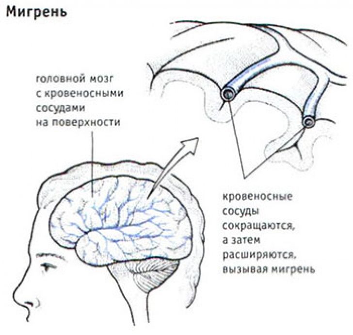 Что происходит при мигрени. Мигрень. Мигрень головного мозга. Что такое мигрень головы. Мигрень и сосуды головного мозга.