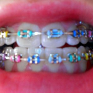 rainbow-braces-for-teeth