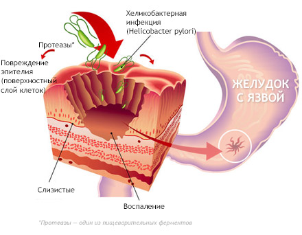 Симптомы развития язвы желудка thumbnail