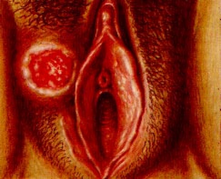 отек половых губ при сифилисе