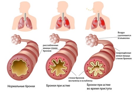 Стадии болезни бронхиальная астма thumbnail