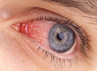 Аденовирусная инфекция глаз у детей симптомы лечение thumbnail