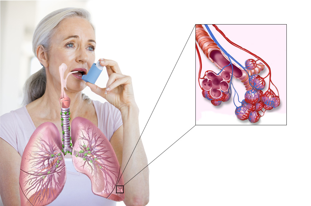 Бронхиальная астма стадии течения thumbnail