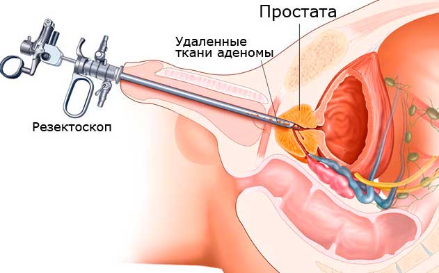 Аденома предстательной железы лечение безоперационное лечение thumbnail