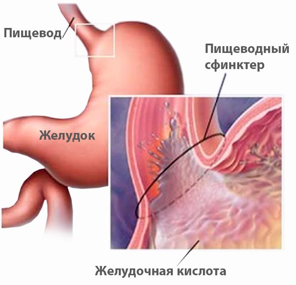 Органическая диспепсия желудка лечение thumbnail
