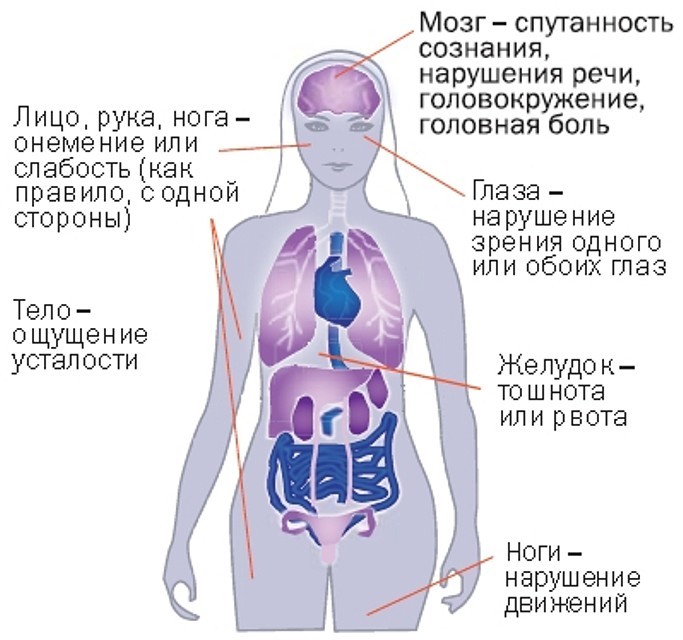 Принимающая сторона тела. Слабость в организме. Онемение одной половины тела. Млеет левая сторона тела. Инсульт симптомы у женщин левая сторона тела.
