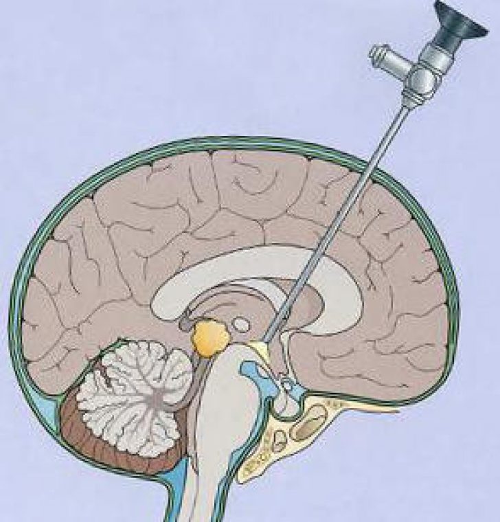 Как выглядит шунт. Гидроцефалия эндоскопия головного мозга. Эндоскопическая вентрикулостомия III желудочка. Шунт головного мозга при гидроцефалии. Эндоскопическая хирургия гидроцефалия головного мозга.