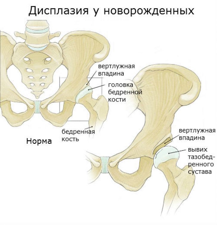 Что такое тбс. 2х сторонняя дисплазия тазобедренных суставов. Дисплазия тазобедренных суставов 3ст. Классификация дисплазии тазобедренных суставов. Дисплазия бедренной кости у новорожденного.