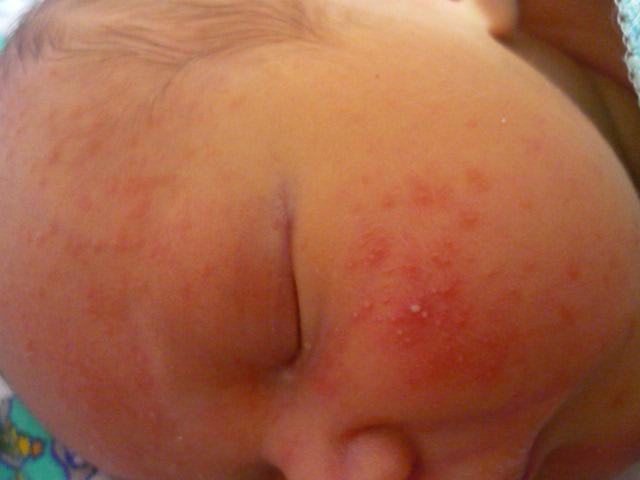 Контактная аллергия фото у взрослых thumbnail