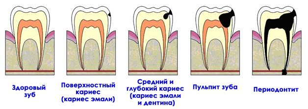 Классификация кариеса лечение зубов thumbnail