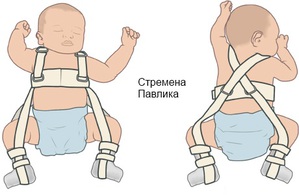 Дисплазия тазобедренных суставов у детей до года новорожденных: лечение и признаки с фото