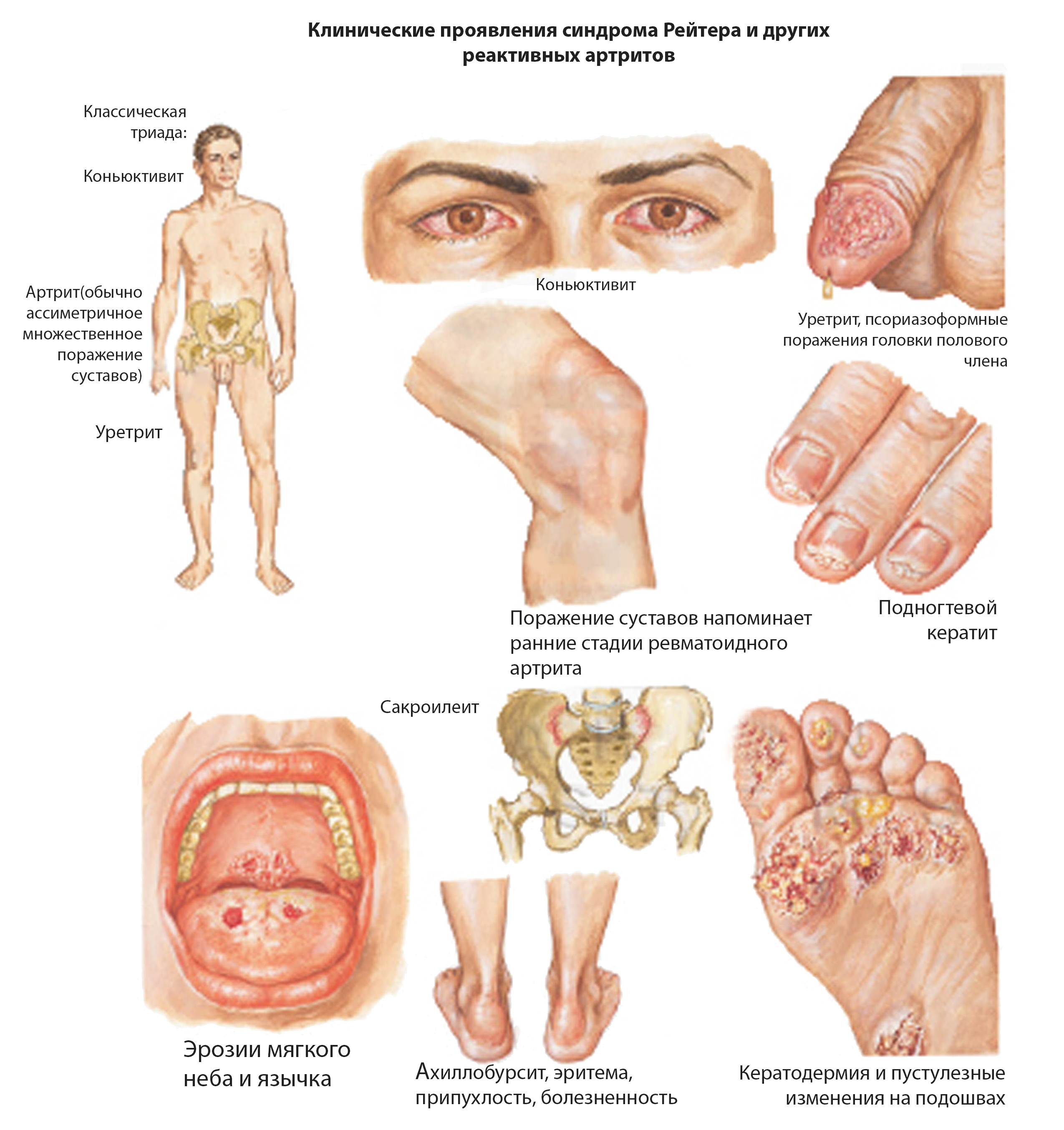 Ревматический артрит симптомы лечение