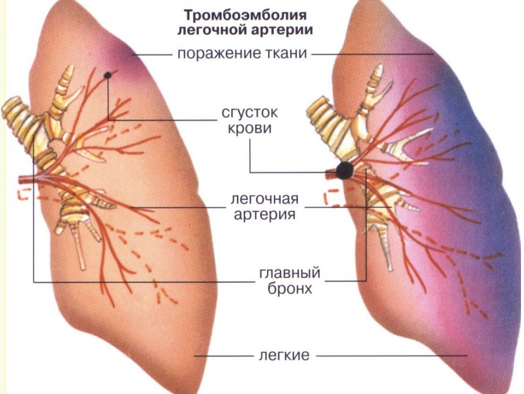 Ветви в легких. Тромбоэмболия ветвей легочной артерии. Эмболия тромбом легочной артерии (Тэла);. Тромбоэмболия крупных ветвей легочной артерии. Тромбоз лёгочной артерии симптомы.