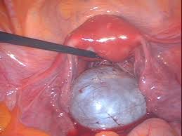 Профилактика кисты яичника у женщин thumbnail