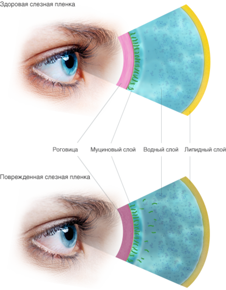 Сухие глаза (синдром сухого глаза). Синдром сухого глаза симптомы. Синдром сухого глаза причины. Слезная пленка глаза.