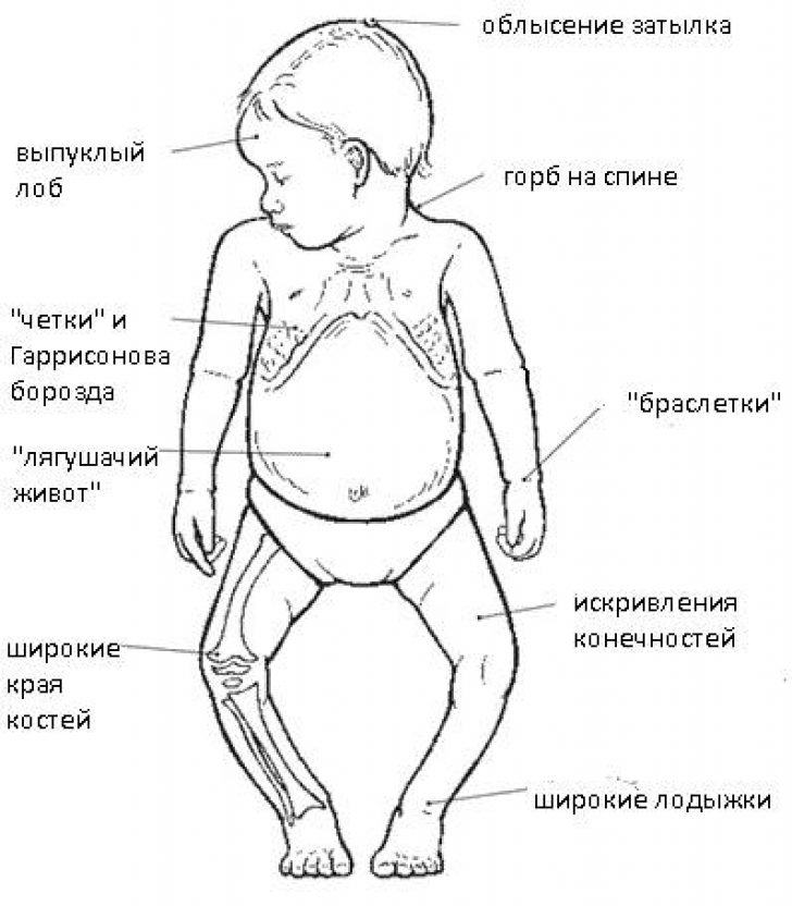 Причины заболевания рахита. Симптомы рахита Гаррисонова борозда. Симптомы рахита у грудничка в 6 месяцев. Рахит (дефицит витамина d). Рахит у 7 месячного ребенка.
