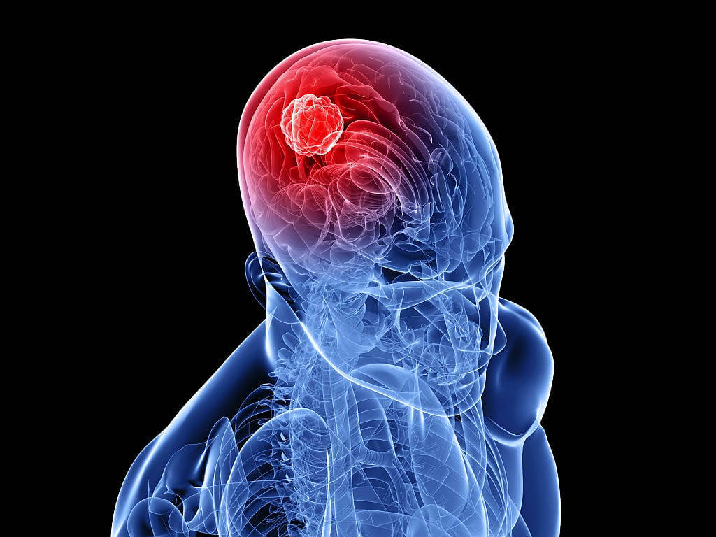 Опухоль головного мозга - это... Что такое Опухоль головного мозга?