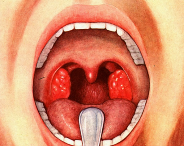 Схема лечения герпетической ангины thumbnail