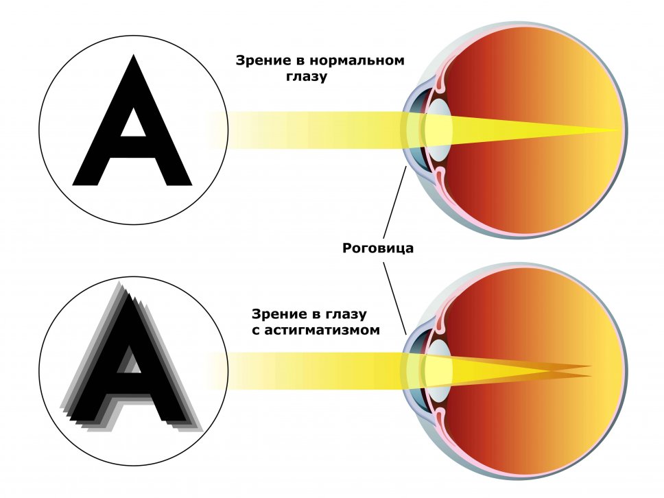 astigmatiz