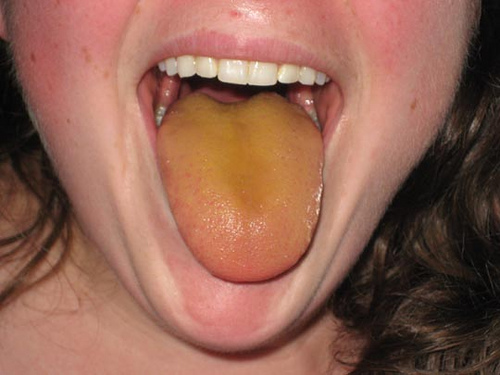 Болит в правом боку и язык желтый с налетом thumbnail