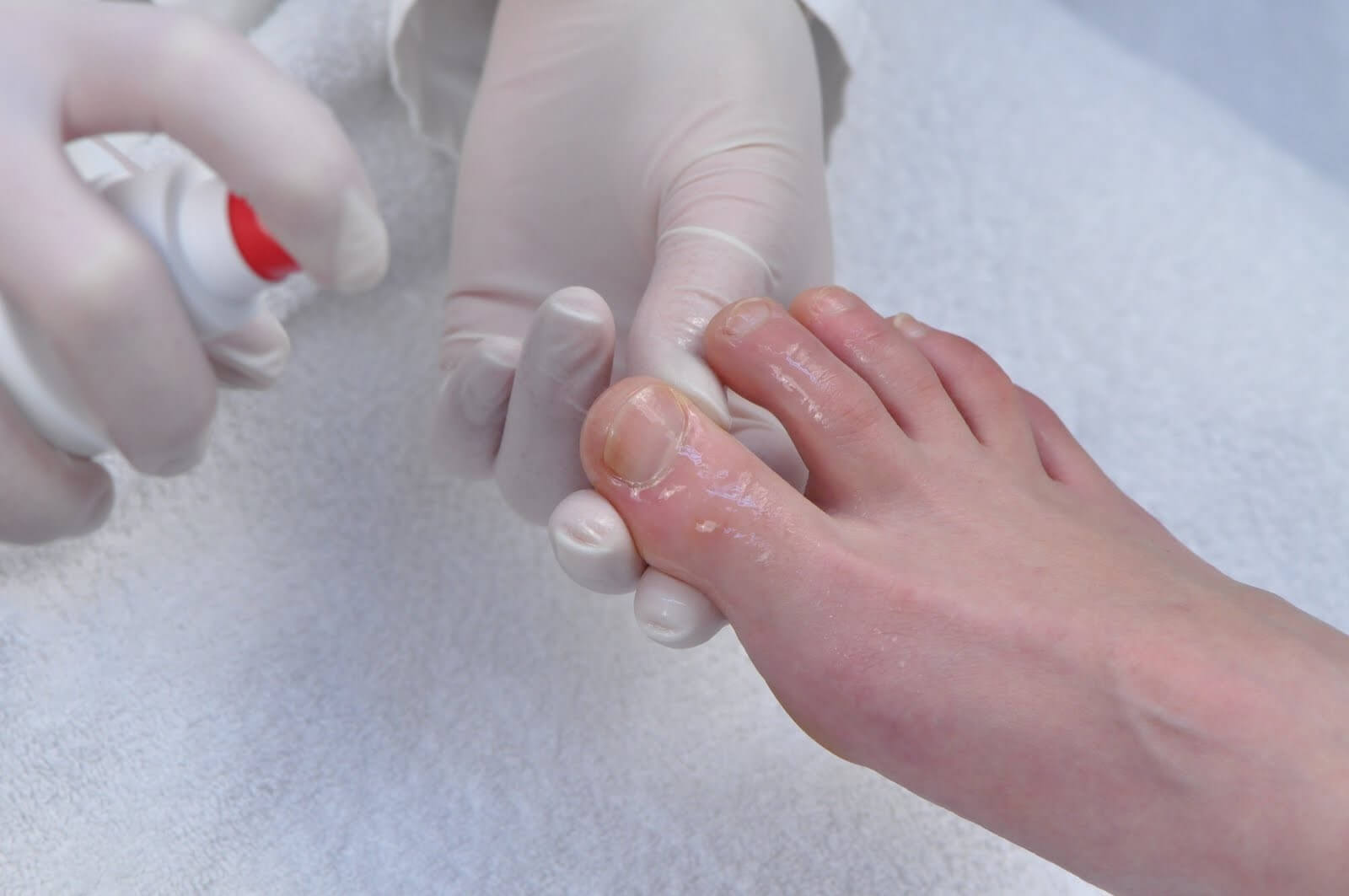 Лечение ногтевого грибка на ногах. Подология грибок ногтей. Дисгидротическая эпидермофития. Грибковые инфекции ногтей онихомикозы.