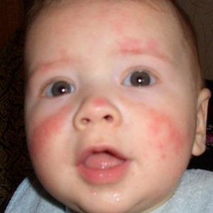 На что у детей до года бывает аллергия thumbnail
