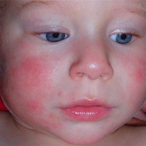 Как лечить аллергию детям до года thumbnail