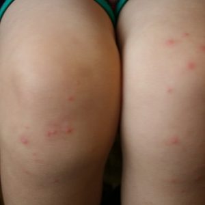 Аллергию с кожи рук и ног у детей thumbnail