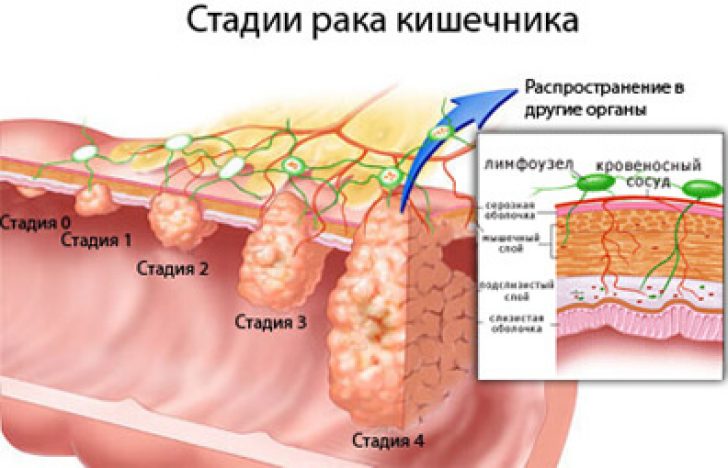 Описание стадий рака. Онкология кишечника 4 стадии.