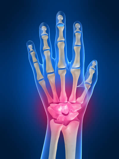 Симптомы и лечение артрита в лучезапястном суставе thumbnail