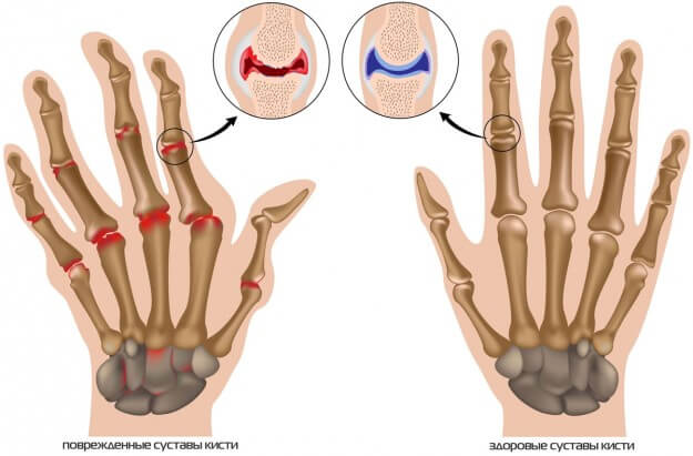 Почему болят пальцы рук