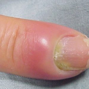Лечение нарыва на пальце в домашних thumbnail
