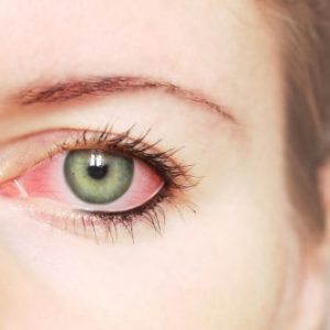 Раздражение слизистой глаза лечение в домашних условиях thumbnail
